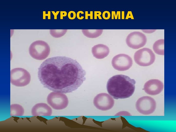 HYPOCHROMIA 