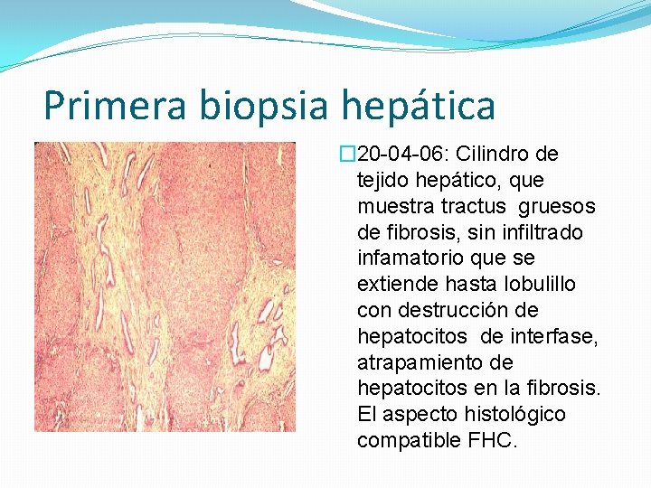 Primera biopsia hepática � 20 -04 -06: Cilindro de tejido hepático, que muestra tractus