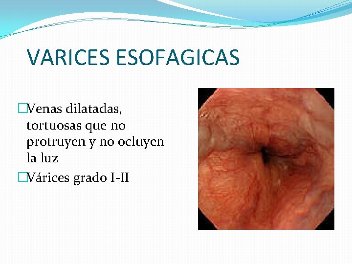 VARICES ESOFAGICAS �Venas dilatadas, tortuosas que no protruyen y no ocluyen la luz �Várices