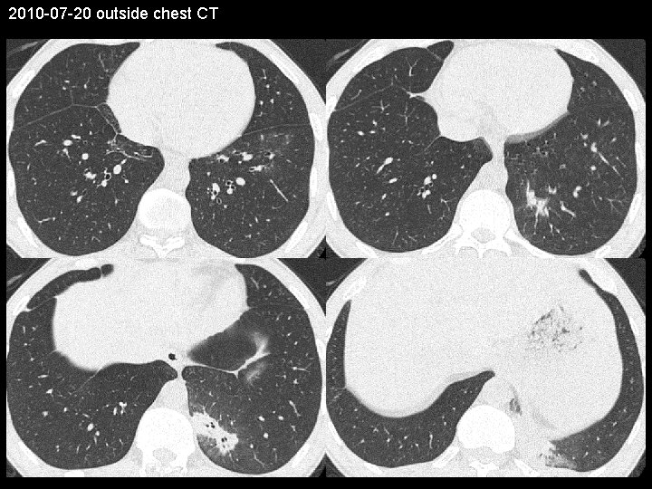 2010 -07 -20 outside chest CT 