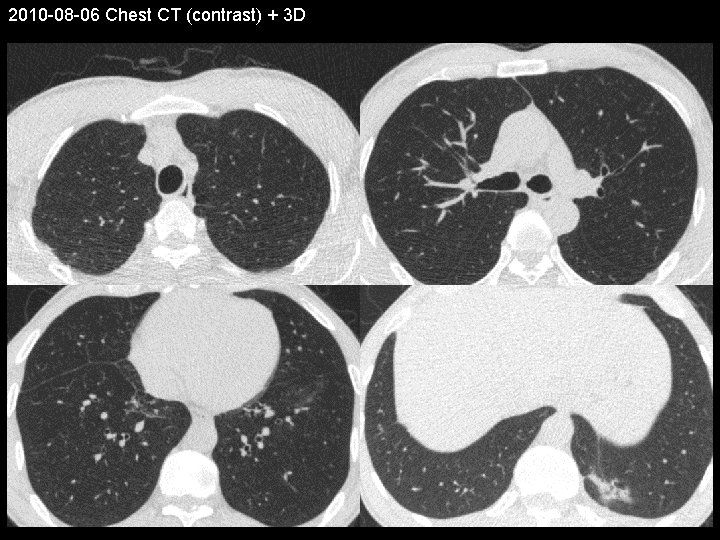 2010 -08 -06 Chest CT (contrast) + 3 D 