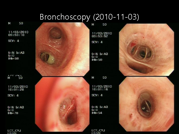 Bronchoscopy (2010 -11 -03) Title 