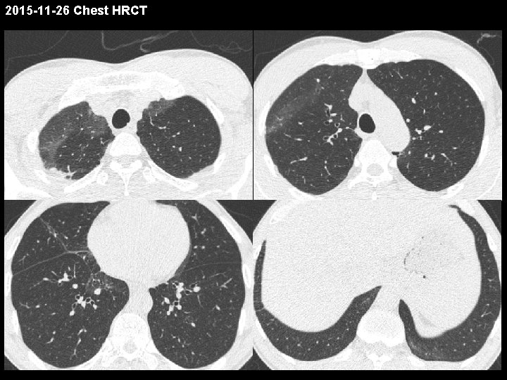 2015 -11 -26 Chest HRCT 2015 -11 -26 