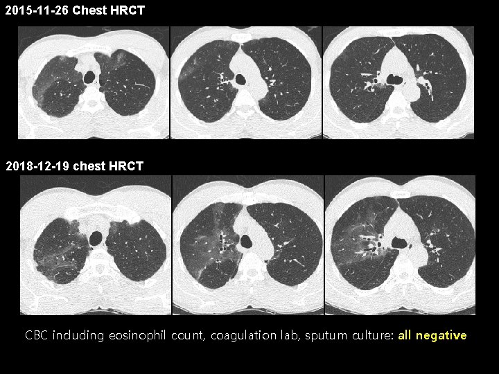 2015 -11 -26 Chest HRCT Title 2018 -12 -19 chest HRCT CBC including eosinophil
