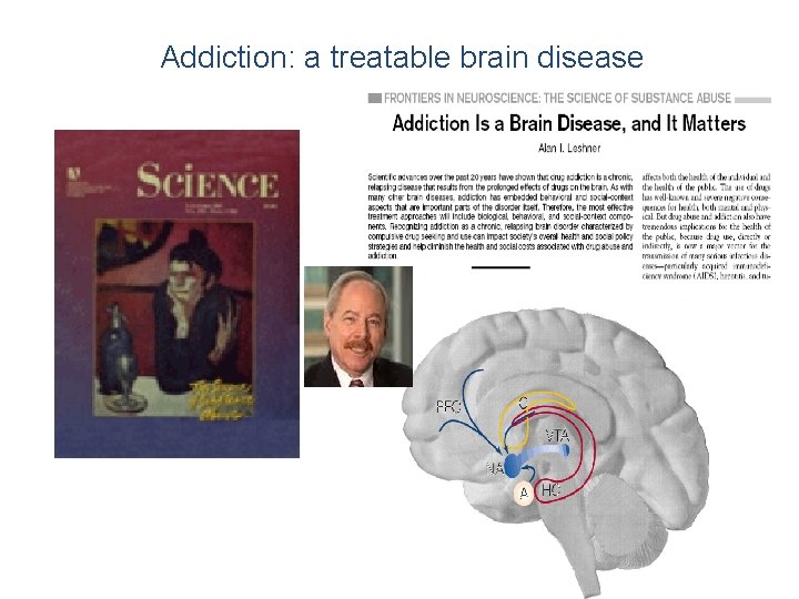 Addiction: a treatable brain disease 