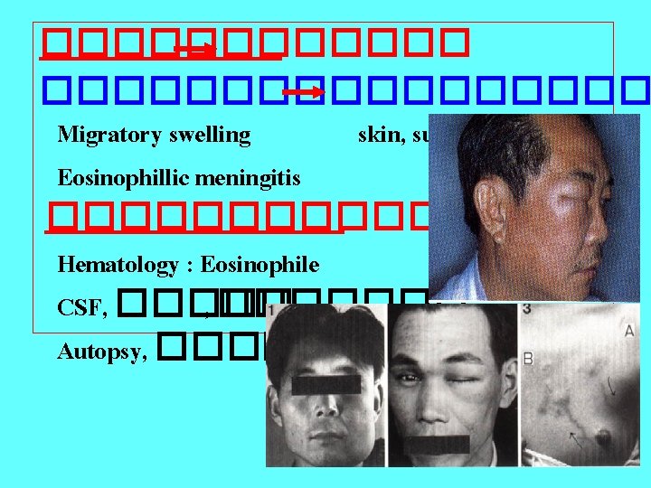 ��������� Migratory swelling skin, subcutaneous Eosinophillic meningitis �������� Hematology : Eosinophile CSF, ������� Autopsy,