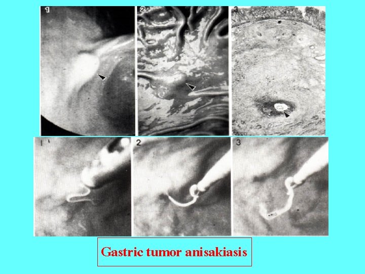 Gastric tumor anisakiasis 