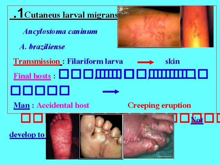 . 1 Cutaneus larval migrans: Ancylostoma caninum A. braziliense Transmission : Filariform larva skin