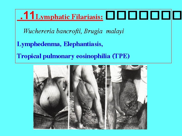 . 11 Lymphatic Filariasis: ������� Wuchereria bancrofti, Brugia malayi Lymphedenma, Elephantiasis, Tropical pulmonary eosinophilia