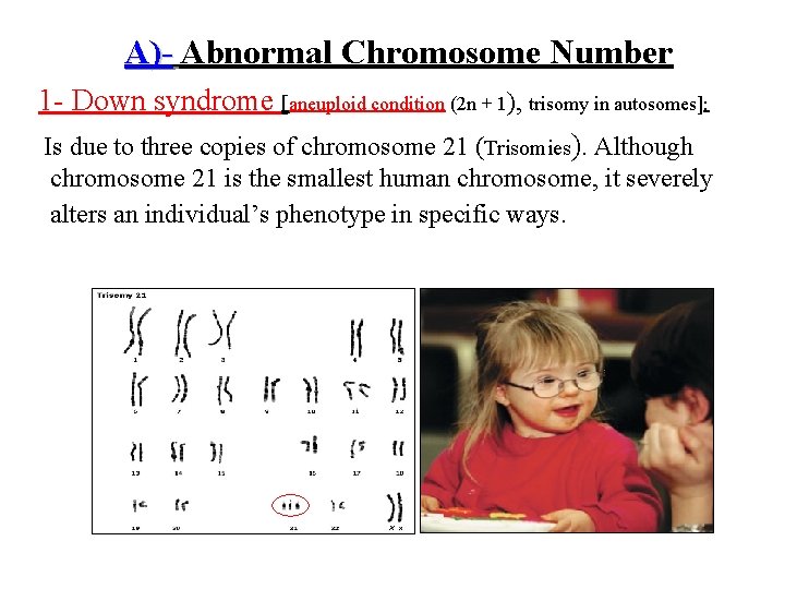 A)- Abnormal Chromosome Number 1 - Down syndrome [aneuploid condition (2 n + 1),