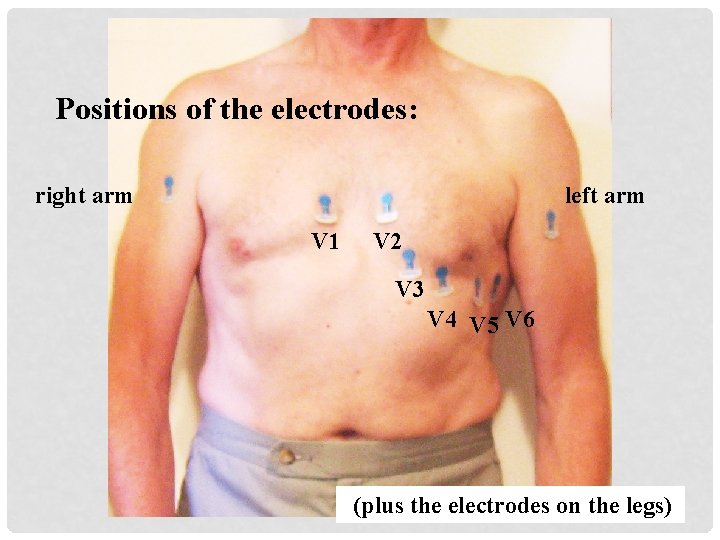 Positions of the electrodes: right arm left arm V 1 V 2 V 3