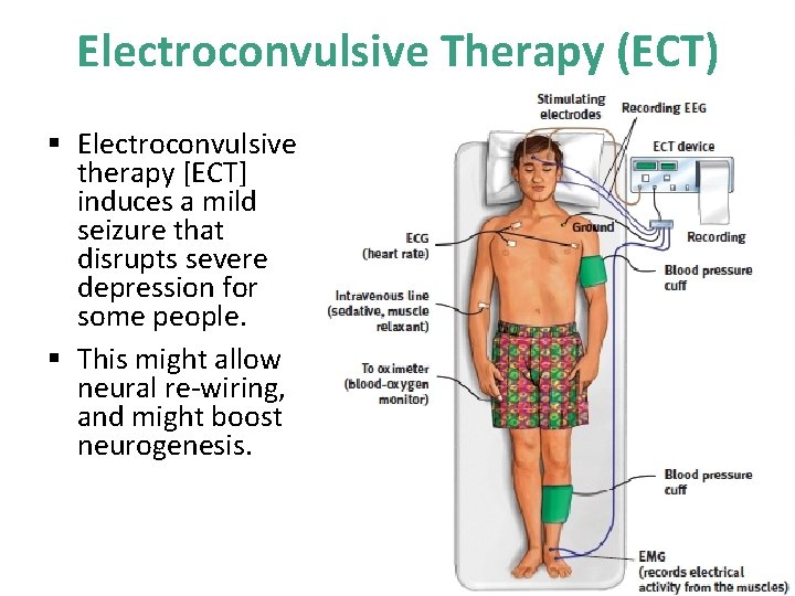 Electroconvulsive Therapy (ECT) § Electroconvulsive therapy [ECT] induces a mild seizure that disrupts severe