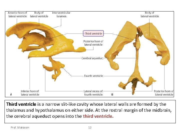 Third ventricle is a narrow slit-like cavity whose lateral walls are formed by the