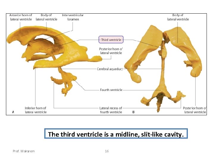 The third ventricle is a midline, slit-like cavity. Prof. Makarem 16 