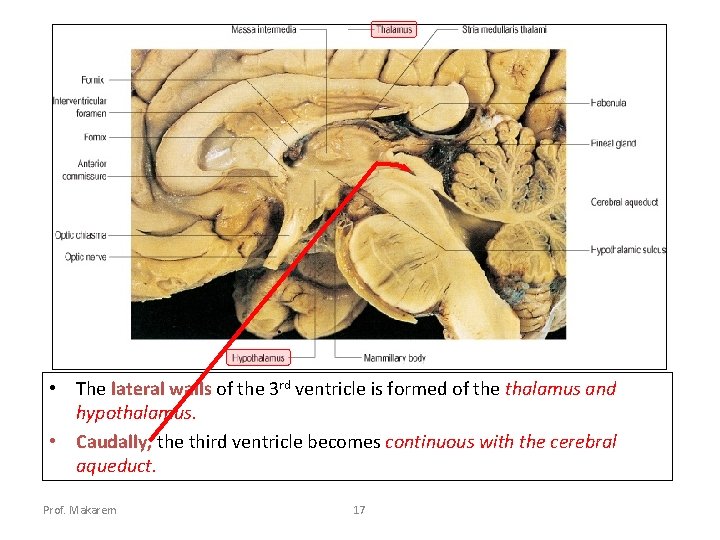  • The lateral walls of the 3 rd ventricle is formed of the