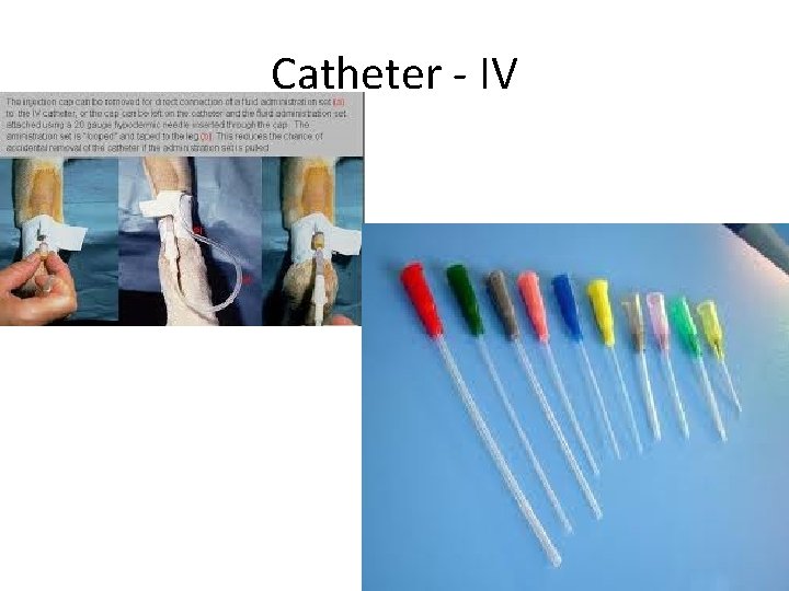 Catheter - IV 