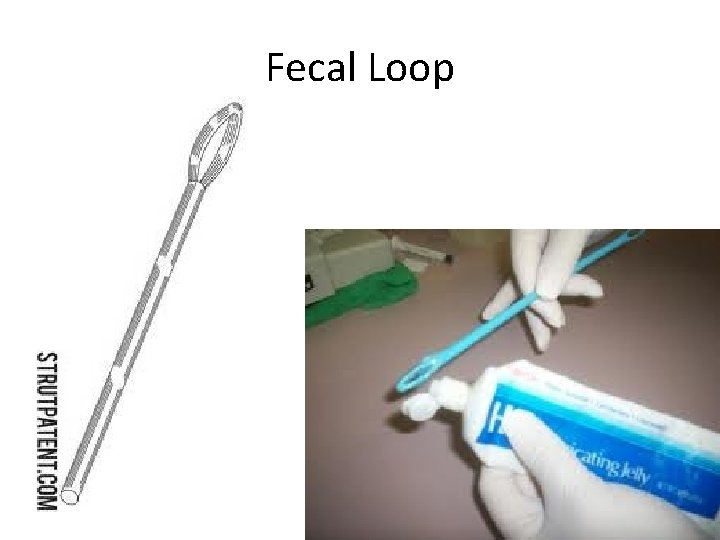 Fecal Loop 