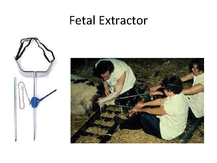 Fetal Extractor 