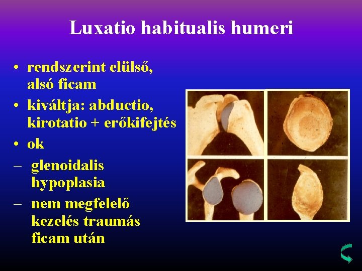 Luxatio habitualis humeri • rendszerint elülső, alsó ficam • kiváltja: abductio, kirotatio + erőkifejtés
