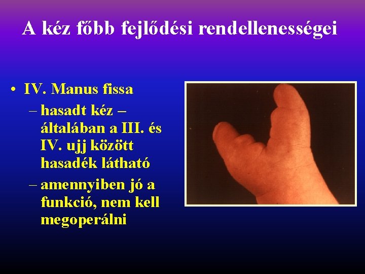 A kéz főbb fejlődési rendellenességei • IV. Manus fissa – hasadt kéz – általában