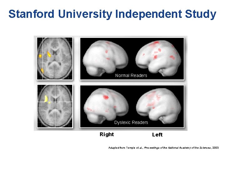 Stanford University Independent Study Normal Readers Dyslexic Readers Right Left Adapted from Temple et