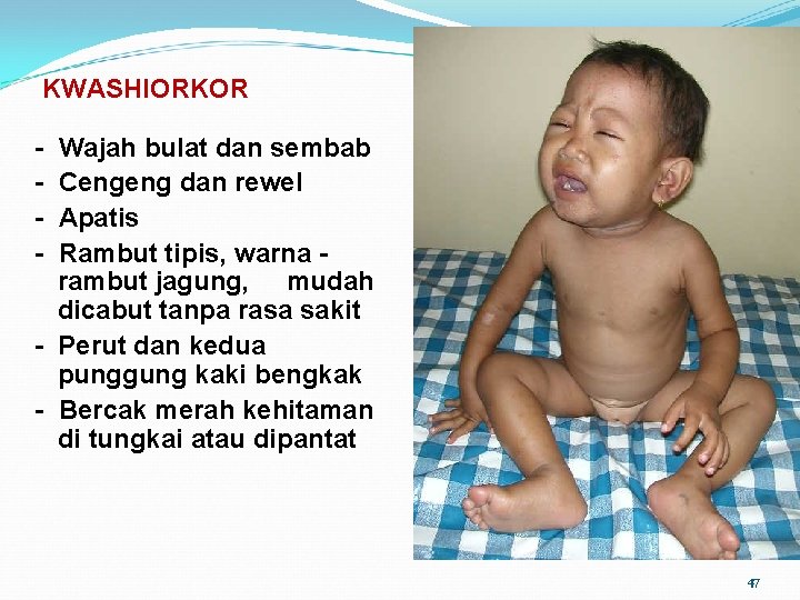  KWASHIORKOR - Wajah bulat dan sembab Cengeng dan rewel Apatis Rambut tipis, warna