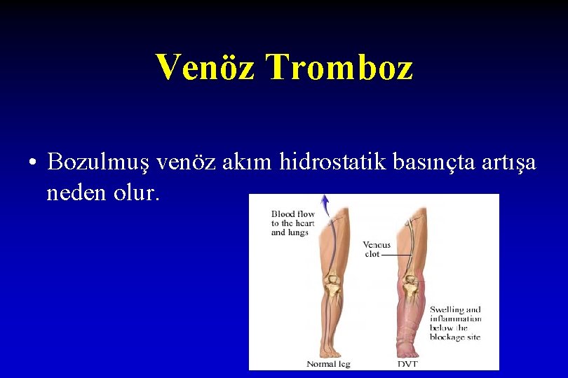 Venöz Tromboz • Bozulmuş venöz akım hidrostatik basınçta artışa neden olur. 