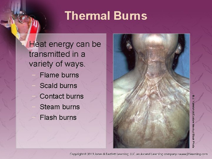 Thermal Burns • Heat energy can be transmitted in a variety of ways. Flame