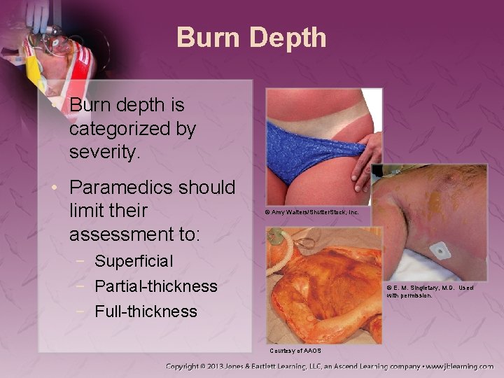Burn Depth • Burn depth is categorized by severity. • Paramedics should limit their
