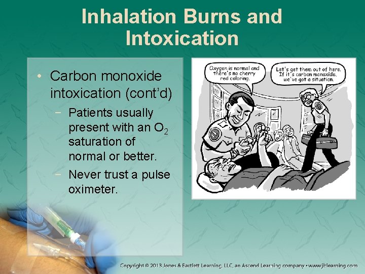 Inhalation Burns and Intoxication • Carbon monoxide intoxication (cont’d) − Patients usually present with