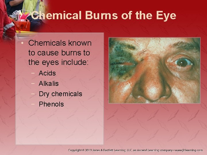 Chemical Burns of the Eye • Chemicals known to cause burns to the eyes