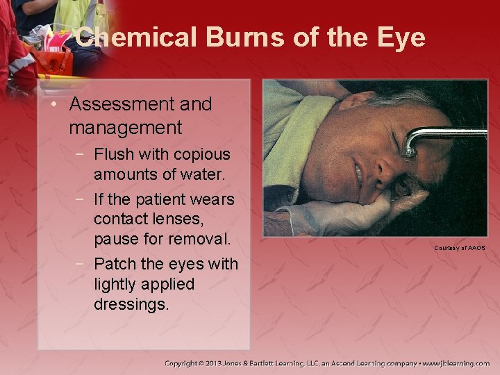 Chemical Burns of the Eye • Assessment and management − Flush with copious amounts