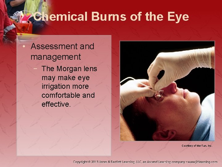 Chemical Burns of the Eye • Assessment and management − The Morgan lens may