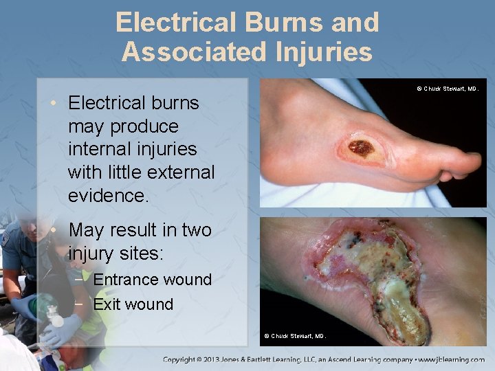 Electrical Burns and Associated Injuries © Chuck Stewart, MD. • Electrical burns may produce