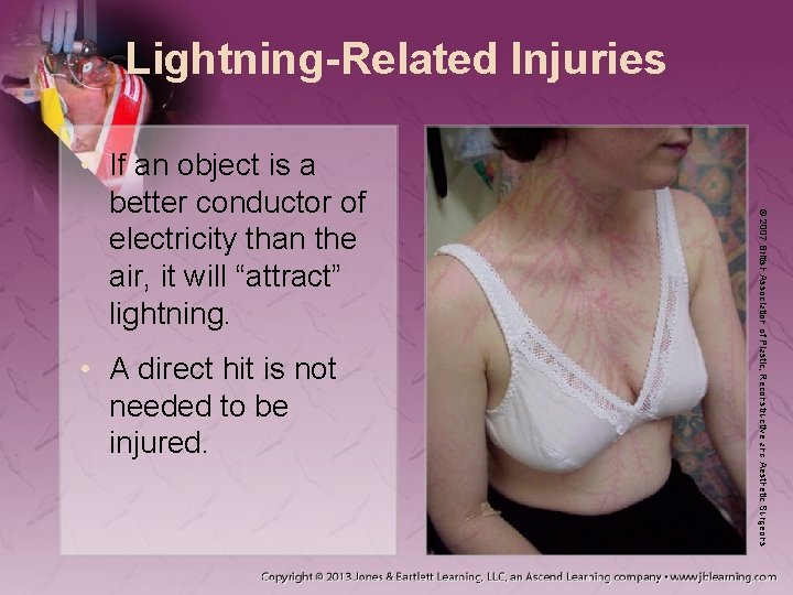 Lightning-Related Injuries • A direct hit is not needed to be injured. © 2007