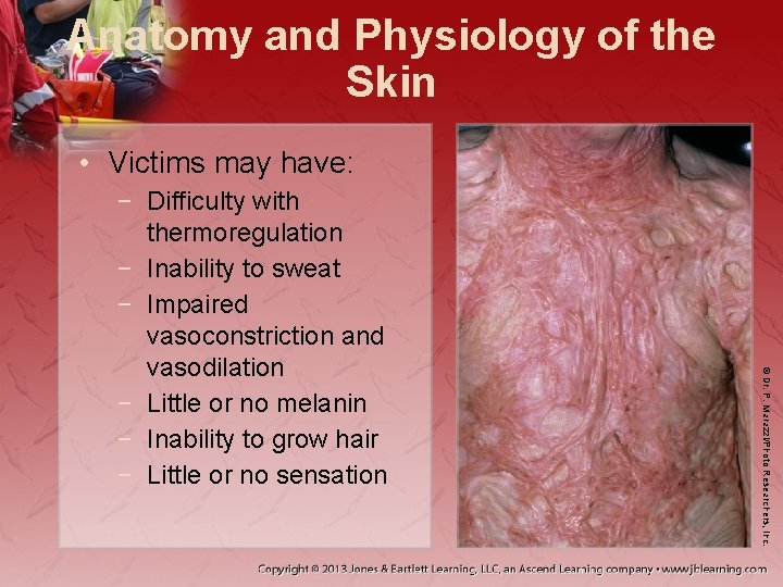 Anatomy and Physiology of the Skin • Victims may have: © Dr. P. Marazzi/Photo