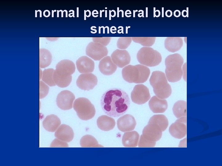 normal peripheral blood smear 