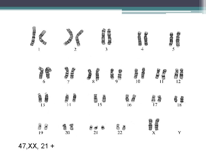 47, XX, 21 + 