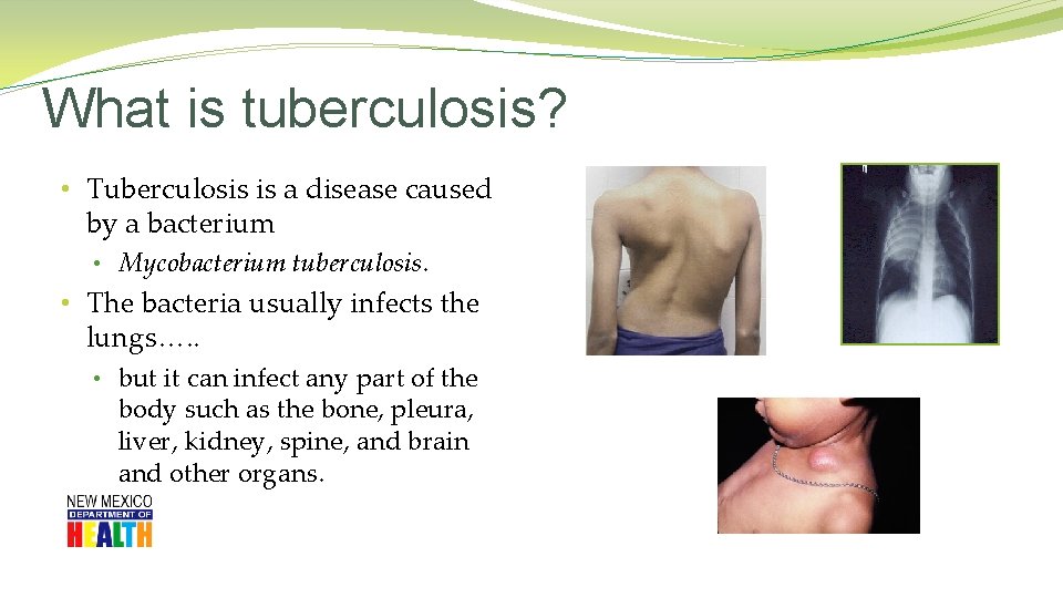What is tuberculosis? • Tuberculosis is a disease caused by a bacterium • Mycobacterium