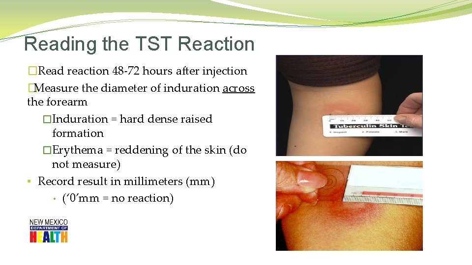 Reading the TST Reaction �Read reaction 48 -72 hours after injection �Measure the diameter