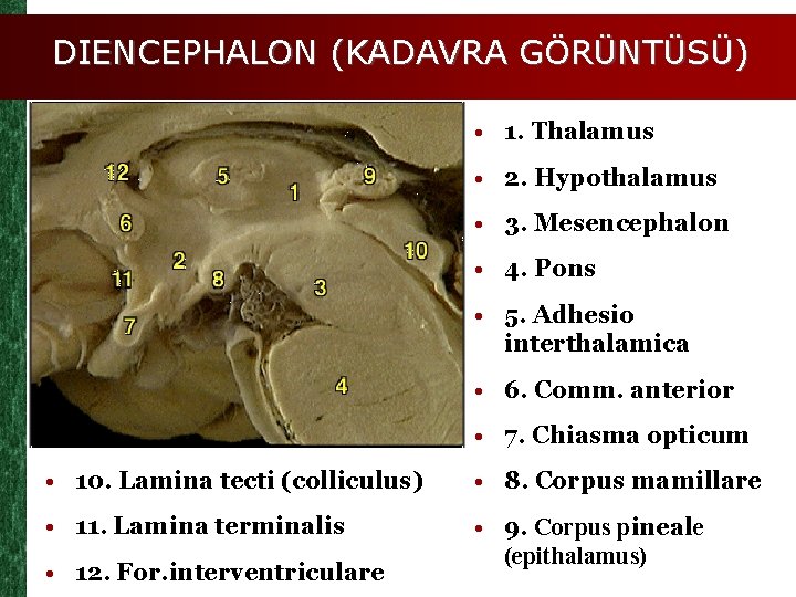 DIENCEPHALON (KADAVRA GÖRÜNTÜSÜ) • 1. Thalamus • 2. Hypothalamus • 3. Mesencephalon • 4.