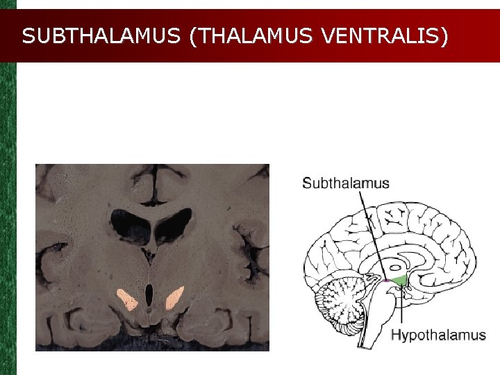 SUBTHALAMUS (THALAMUS VENTRALIS) 