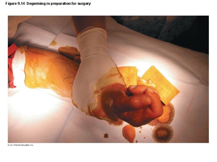 Figure 9. 14 Degerming in preparation for surgery 