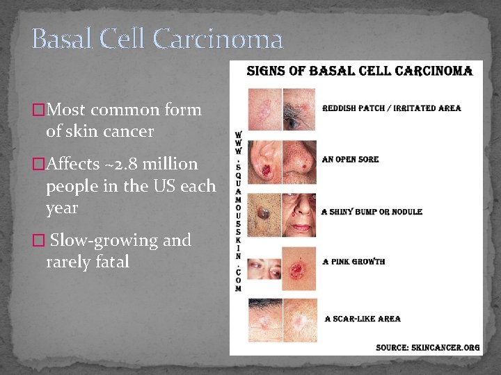 Basal Cell Carcinoma �Most common form of skin cancer �Affects ~2. 8 million people