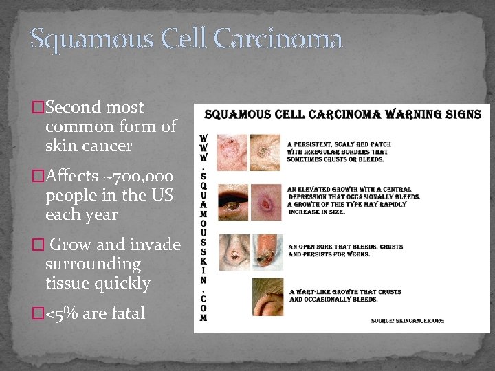 Squamous Cell Carcinoma �Second most common form of skin cancer �Affects ~700, 000 people