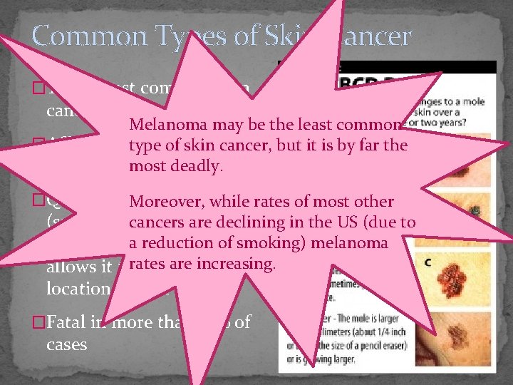 Common Types of Skin Cancer �Third most common skin cancer Melanoma may be the