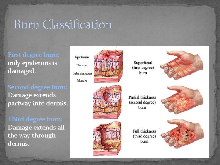 Burn Classification First degree burn: only epidermis is damaged. Second degree burn: Damage extends
