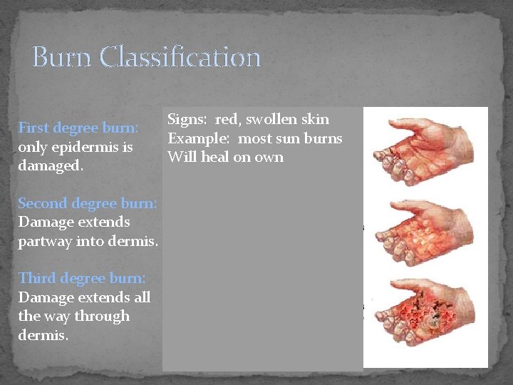 Burn Classification First degree burn: only epidermis is damaged. Second degree burn: Damage extends