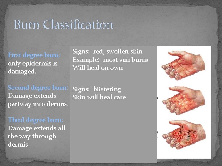 Burn Classification First degree burn: only epidermis is damaged. Signs: red, swollen skin Example: