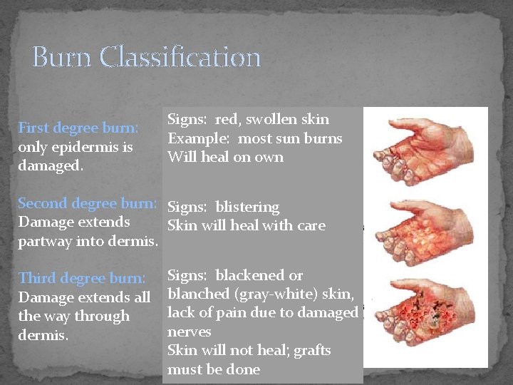 Burn Classification First degree burn: only epidermis is damaged. Signs: red, swollen skin Example: